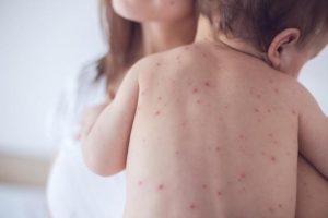 В Запорожье за неделю еще несколько человек заболело корью: как себя уберечь