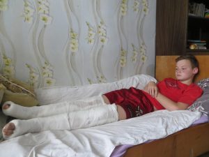В Бердянске подросток сломал обе ноги: у родителей нет денег на лечение в Запорожье