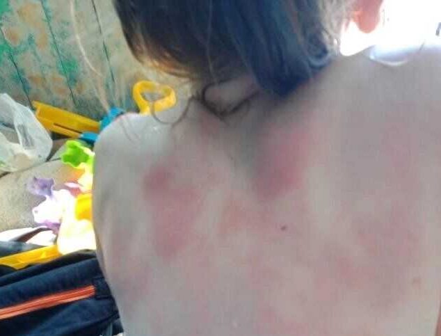 После купания в Кирилловке тело ребенка покрылось красными пятнами (ФОТО)
