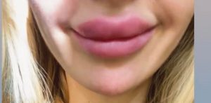 Скандал в Запорожье: уколы красоты обернулись десяткам девушек уродством (ФОТО)