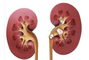 Лазерна літотрипсія – майбутнє урології вже сьогодні