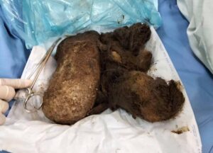 У 15-летней девочки из Запорожья удалили из желудка килограммовый комок волос