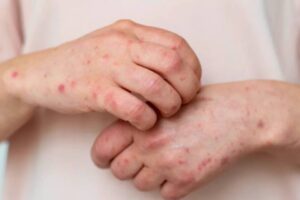 У Запоріжжі виявили перший за 5 років випадок кору